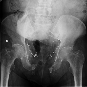 Long-term Pelvic Function After Symphysis Pubectomy for Urosymphyseal ...