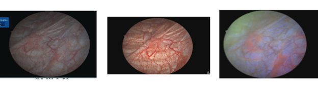 Images of the same area of interest in a flat, carcinoma in situ bladder lesion: a) White Light Cystoscopy,  b) CHROMA, c) Blue Light Cystoscopy.